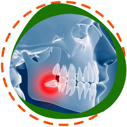 Cirugía oral y muelas del juicio